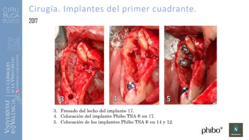 5.Implantes Palatinizados. Implantes Phibo TSA 12_page-0001