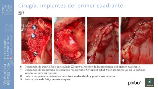 5.Implantes Palatinizados. Implantes Phibo TSA 13_page-0001