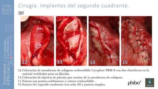 5.Implantes Palatinizados. Implantes Phibo TSA 15_page-0001