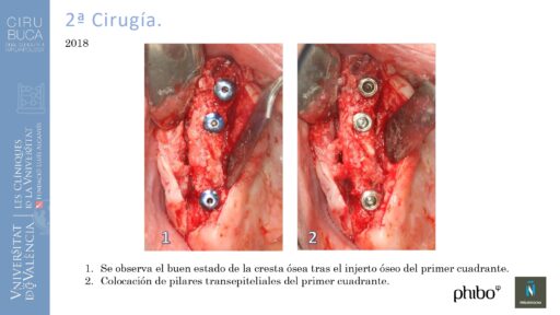 5.Implantes Palatinizados. Implantes Phibo TSA 20_page-0001