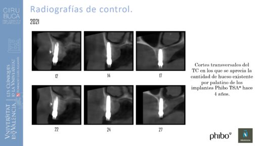 5.Implantes Palatinizados. Implantes Phibo TSA 31_page-0001