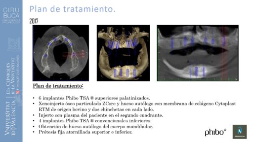 5.Implantes Palatinizados. Implantes Phibo TSA 6_page-0001