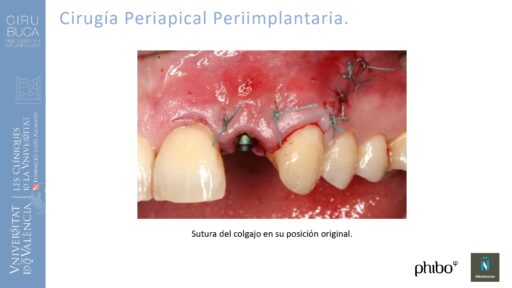 Rosa García Puchades_Cirugia_periapical_periimplantaria