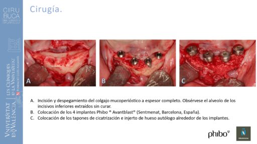 Victoria Bruscas_cirugia_periapical_periimplantaria