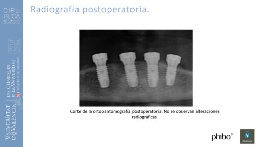 Victoria Bruscas_cirugia_periapical_periimplantaria