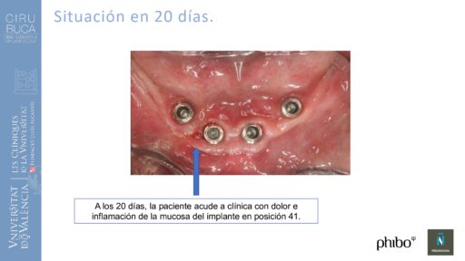 Victoria Bruscas_cirugia_periapical_periimplantaria