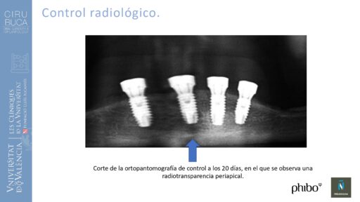 Victoria Bruscas_cirugia_periapical_periimplantaria