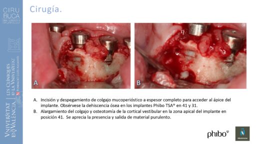 Victoria Bruscas_cirugia_periapical_periimplantaria