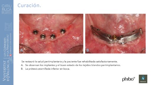 Victoria Bruscas_cirugia_periapical_periimplantaria