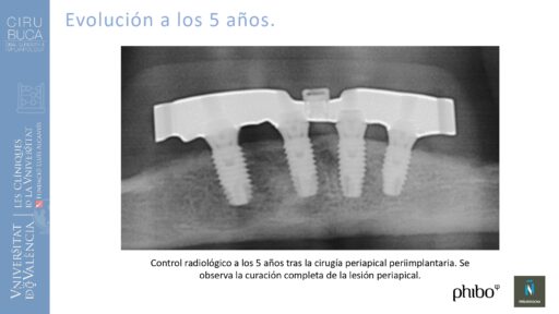 Victoria Bruscas_cirugia_periapical_periimplantaria