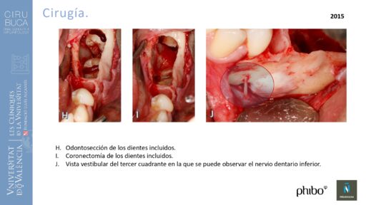 quistectomia-e-implantes-phibo-