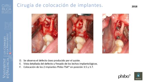 quistectomia-e-implantes-phibo-
