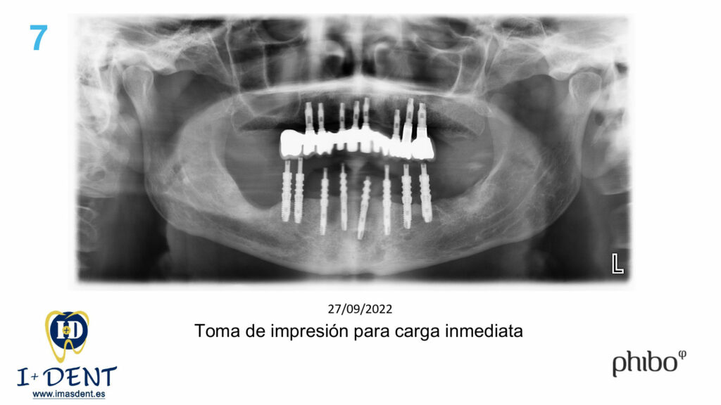 CARGA-INMEDIATA-Inferior-TSH-Oscar-Arias_0007